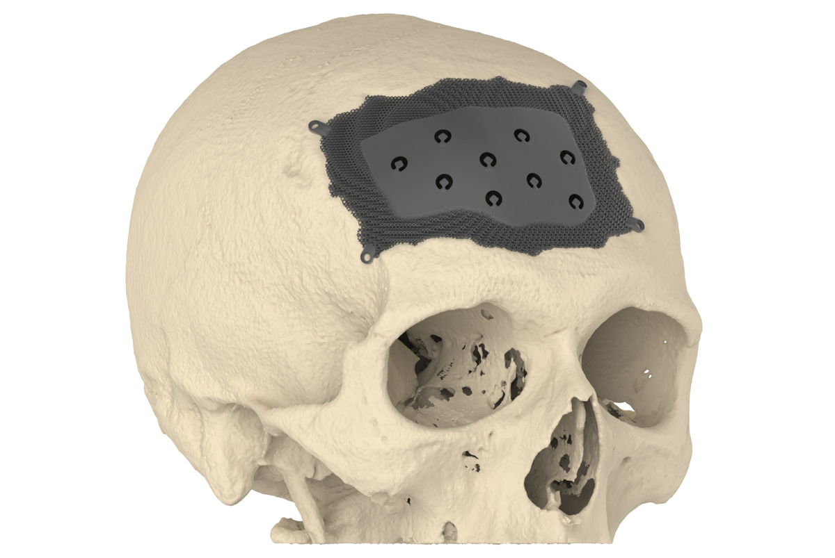 implant en titane imprimé en 3D